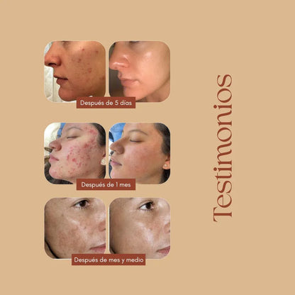Serum Anti acné y Anti Manchas 2x1